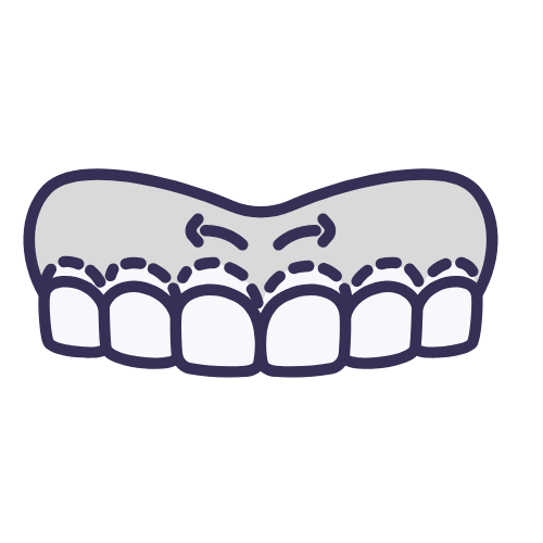 Gingivectomia